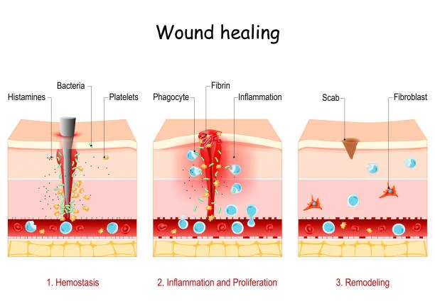 Repair Techniques for Severe Burns